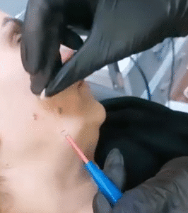 نمونه برداشتن خال دکتر صهبا صمدی