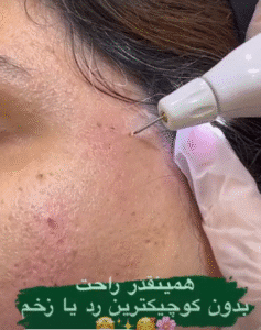 نمونه برداشتن خال کلینیک زیبایی گهربد