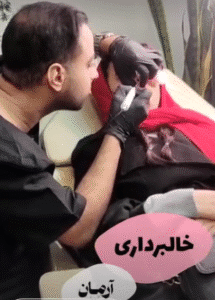 نمونه برداشتن خال کلینیک زیبایی آرمان
