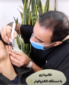 نمونه برداشتن خال کلینیک زیبایی آرمان