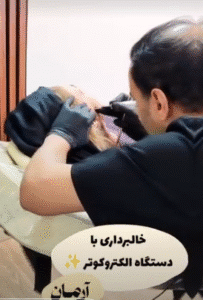 نمونه برداشتن خال کلینیک زیبایی آرمان