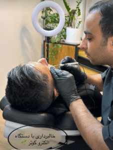 نمونه برداشتن خال کلینیک زیبایی آرمان