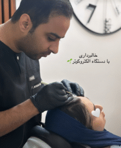 نمونه برداشتن خال کلینیک زیبایی آرمان