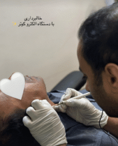 نمونه برداشتن خال کلینیک زیبایی آرمان