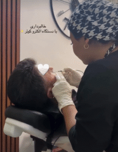 نمونه برداشتن خال کلینیک زیبایی آرمان