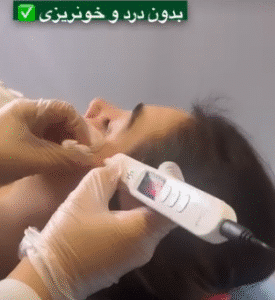 نمونه برداشتن خال کلینیک زیبایی گلدن رویال