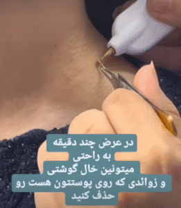نمونه برداشتن خال کلینیک زیبایی گلدن رویال