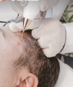 نمونه برداشتن خال دکتر سیاوش وکیلی