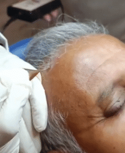 نمونه برداشتن خال دکتر سیاوش وکیلی