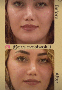 نمونه برداشتن خال دکتر سیاوش وکیلی