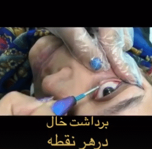 نمونه برداشتن خال دکتر مریم خباززاده
