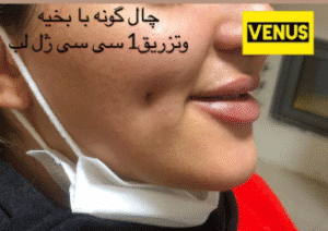 نمونه چال گونه باشگاه سلامت و زیبایی ونوس