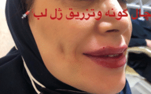 نمونه چال گونه باشگاه سلامت و زیبایی ونوس