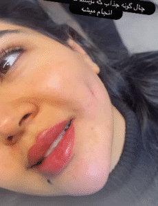 نمونه چال گونه کلینیک زیبایی اکسیر جوانی سایه