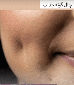 نمونه چال گونه کلینیک زیبایی اکسیر جوانی سایه
