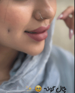 نمونه چال گونه کلینیک زیبایی اکسیر جوانی سایه