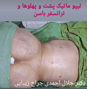 نمونه لیپوماتیک دکتر جلال احمدی