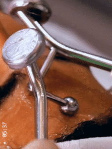 نمونه پاکسازی پوست (کلینیک تخصصی آفرینش)