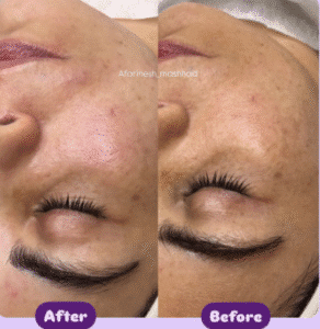 نمونه پاکسازی پوست (کلینیک تخصصی آفرینش)