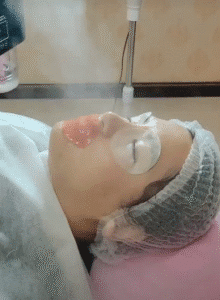 نمونه پاکسازی پوست (کلینیک زیبایی یاس)