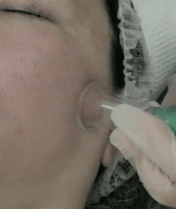 نمونه پاکسازی پوست (کلینیک زیبایی یاس)