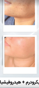 نمونه پاکسازی پوست (کلینیک زیبایی یاس)