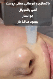 نمونه پاکسازی پوست (کلینیک زیبایی یاس)