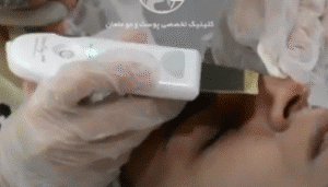 نمونه پاکسازی پوست کلینیک زیبایی ماهان