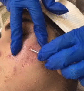 نمونه پاکسازی پوست کلینیک نوآوران زیبایی