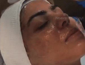 نمونه پاکسازی پوست کلینیک نوآوران زیبایی