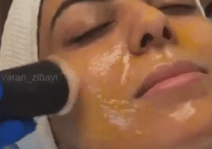 نمونه پاکسازی پوست کلینیک نوآوران زیبایی