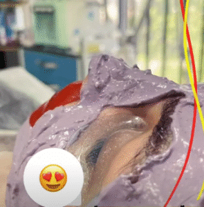 نمونه پاکسازی پوست کلینیک گلدن رویال