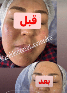 نمونه پاکسازی پوست کلینیک گلدن رویال