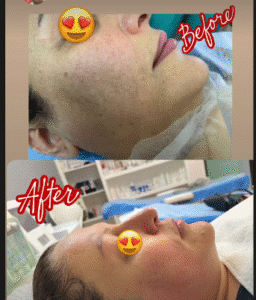 نمونه پاکسازی پوست کلینیک گلدن رویال