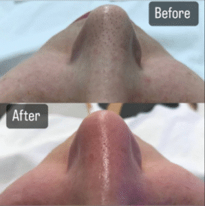 نمونه پاکسازی پوست کلینیک گلدن رویال