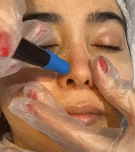 نمونه پاکسازی پوست کلینیک زیبایی بهاران