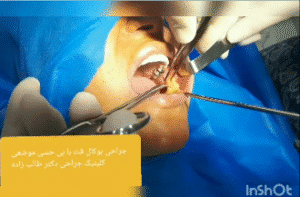 نمونه عمل بوکال فت دکتر حسن طالب زاده