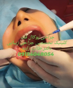 نمونه عمل بوکال فت دکتر حسن طالب زاده