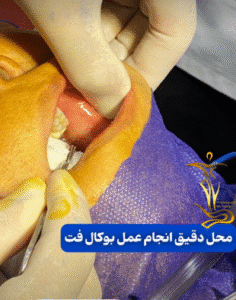 نمونه عمل بوکال فت دکتر حسن طالب زاده