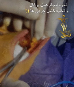 نمونه عمل بوکال فت دکتر حسن طالب زاده