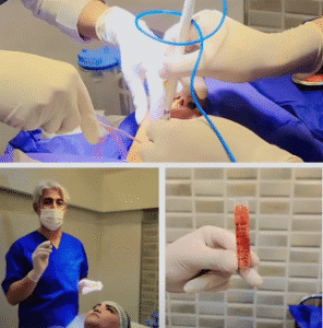 نمونه عمل بوکال فت دکتر حسن طالب زاده