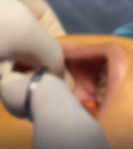 نمونه عمل بوکال فت دکتر حسن طالب زاده