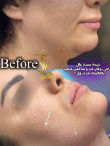 نمونه عمل بوکال فت دکتر حسن طالب زاده