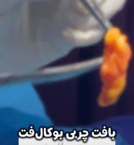 نمونه عمل بوکال فت دکتر حسن طالب زاده