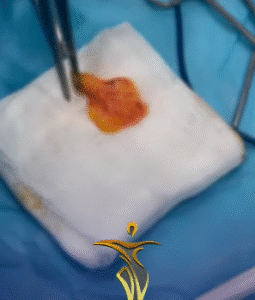 نمونه عمل بوکال فت دکتر حسن طالب زاده