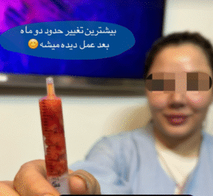 نمونه عمل بوکال فت کلینیک زیبایی آرمان