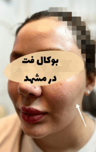 نمونه عمل بوکال فت کلینیک زیبایی آرمان