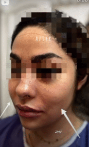 نمونه عمل بوکال فت کلینیک زیبایی آرمان