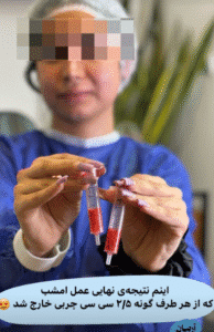 نمونه عمل بوکال فت کلینیک زیبایی آرمان