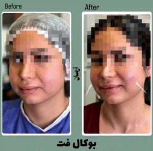 نمونه عمل بوکال فت کلینیک زیبایی آرمان